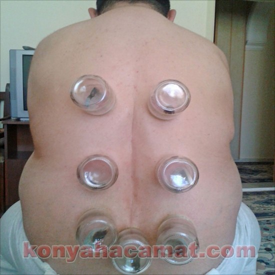 KESKİNOÄžLU; Konya Hacamat terapisi,Hacamat tedavisi,hacamat fiyatları,konya hacamat yapan yerler